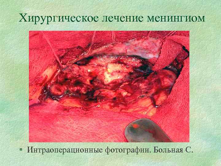 Хирургическое лечение менингиом § Интраоперационные фотографии. Больная С. 