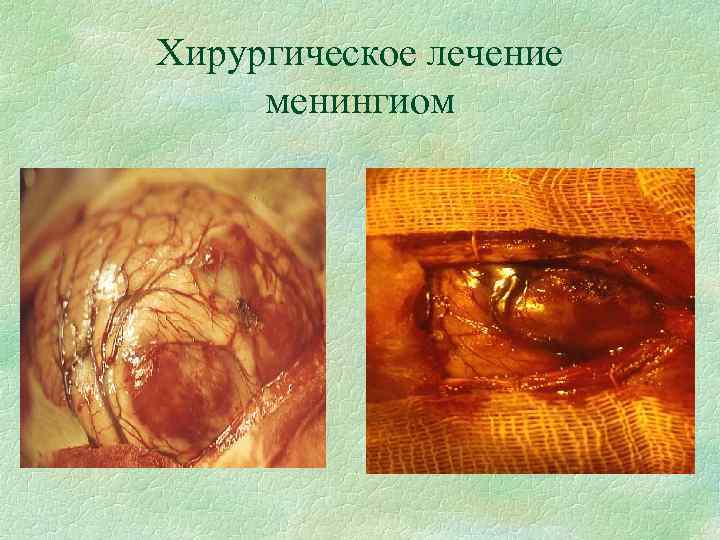 Хирургическое лечение менингиом 