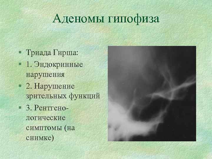Аденомы гипофиза § Триада Гирша: § 1. Эндокринные нарушения § 2. Нарушение зрительных функций