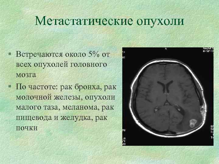 Метастатические опухоли § Встречаются около 5% от всех опухолей головного мозга § По частоте: