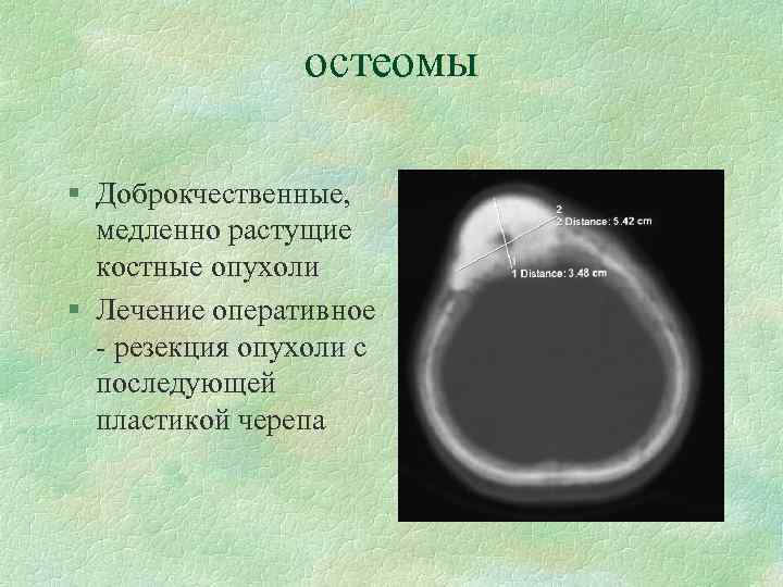 остеомы § Доброкчественные, медленно растущие костные опухоли § Лечение оперативное - резекция опухоли с