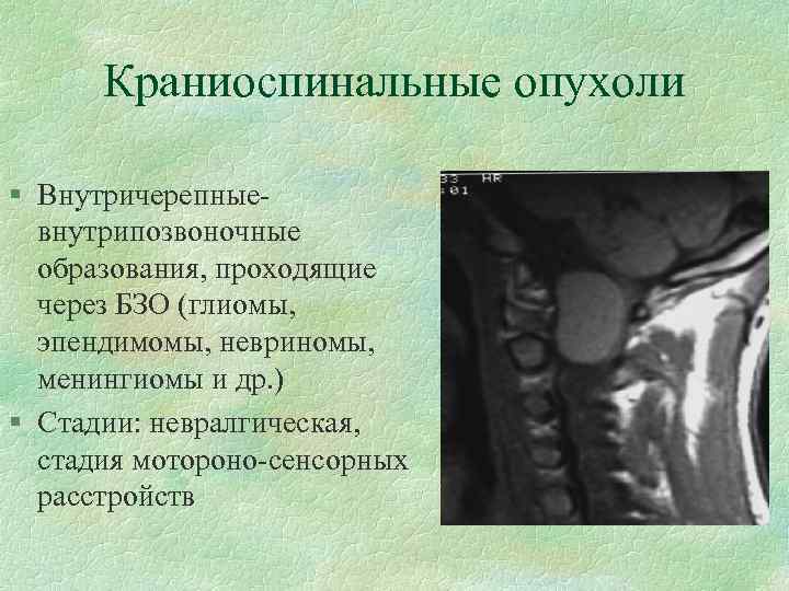 Краниоспинальные опухоли § Внутричерепныевнутрипозвоночные образования, проходящие через БЗО (глиомы, эпендимомы, невриномы, менингиомы и др.