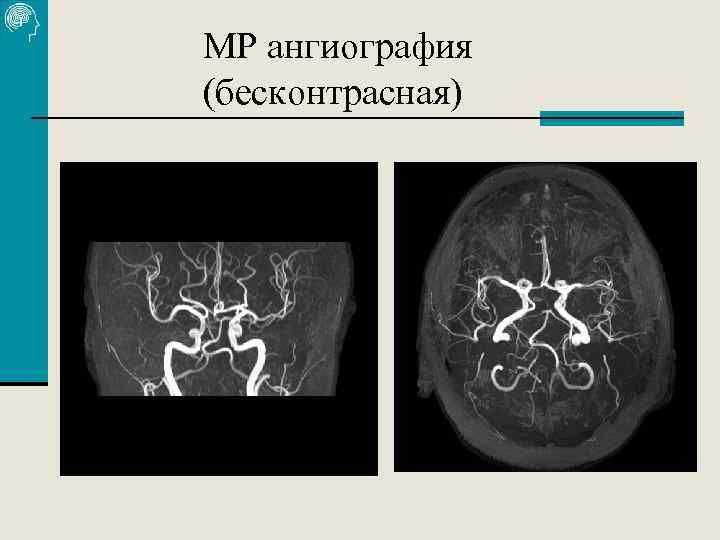 МР ангиография (бесконтрасная) 