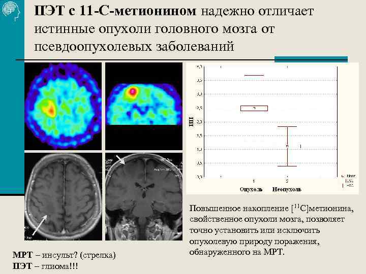 ПЭТ с 11 -С-метионином надежно отличает истинные опухоли головного мозга от псевдоопухолевых заболеваний МРТ