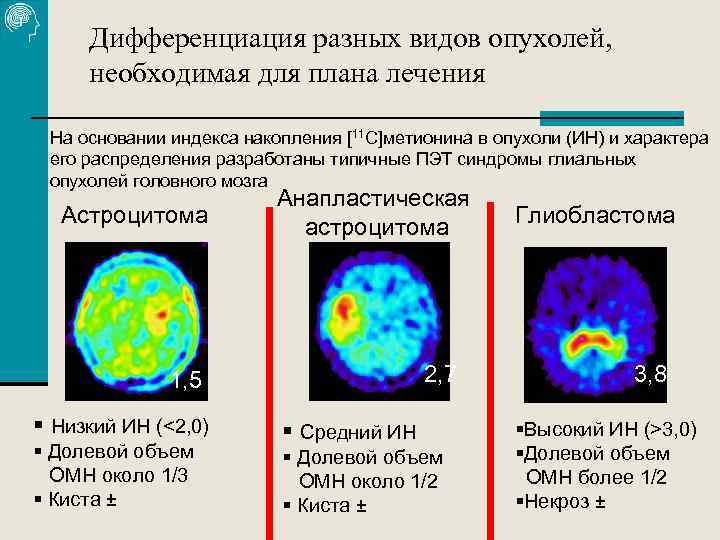 Дифференциация разных видов опухолей, необходимая для плана лечения На основании индекса накопления [11 С]метионина