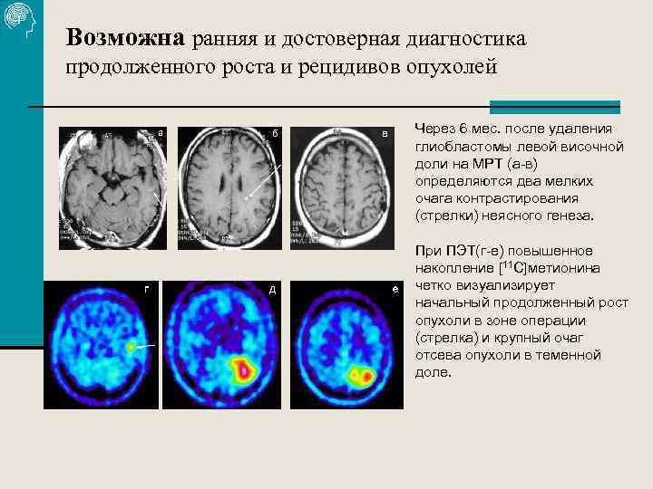 Возможна ранняя и достоверная диагностика продолженного роста и рецидивов опухолей Через 6 мес. после