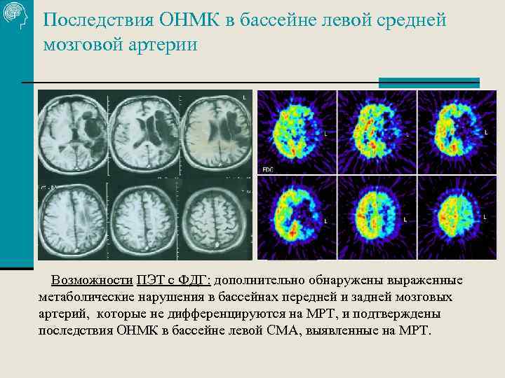 Последствия ОНМК в бассейне левой средней мозговой артерии Возможности ПЭТ с ФДГ: дополнительно обнаружены