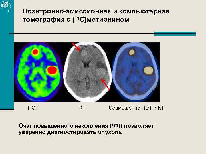 Позитронно-эмиссионная и компьютерная томография с [11 С]метионином ПЭТ КТ Совмещение ПЭТ и КТ Очаг