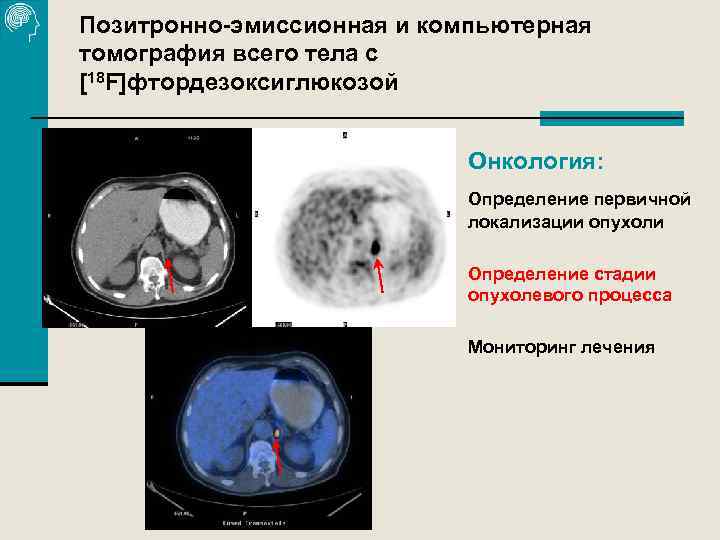 Позитронно-эмиссионная и компьютерная томография всего тела с [18 F]фтордезоксиглюкозой Онкология: Определение первичной локализации опухоли