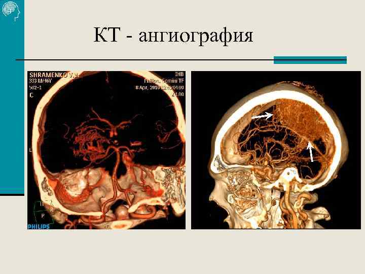 КТ - ангиография 