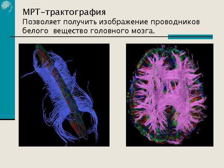 МРТ-трактография Позволяет получить изображение проводников белого вещество головного мозга. 