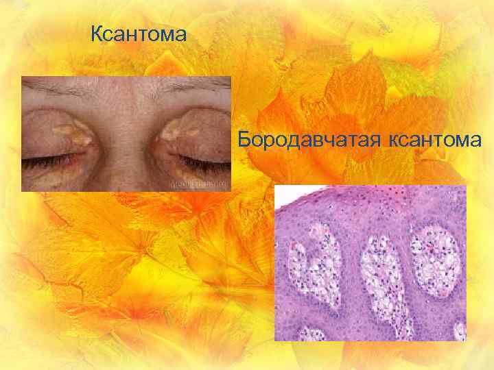 Ксантома Бородавчатая ксантома 