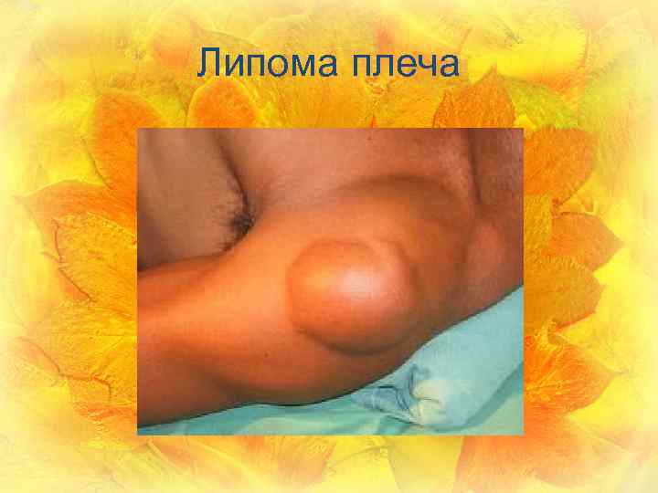 Липома плеча 