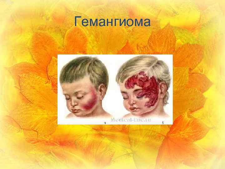 Гемангиома 