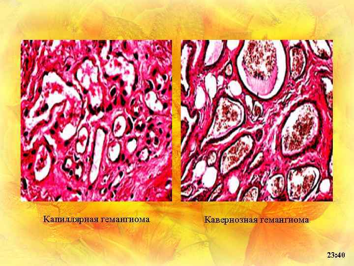 Капиллярная гемангиома Кавернозная гемангиома 23: 40 