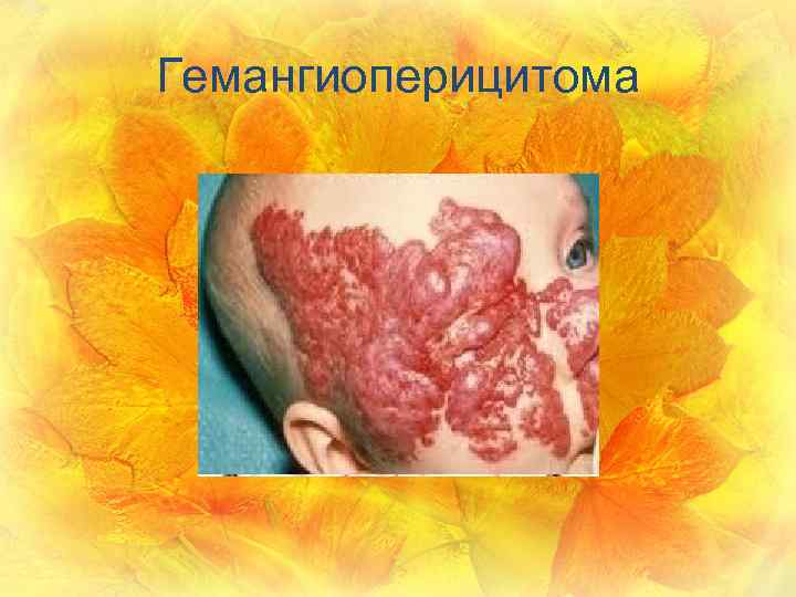 Гемангиоперицитома 