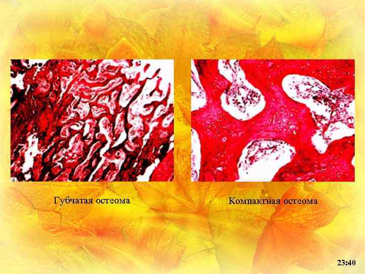 Губчатая остеома Компактная остеома 23: 40 