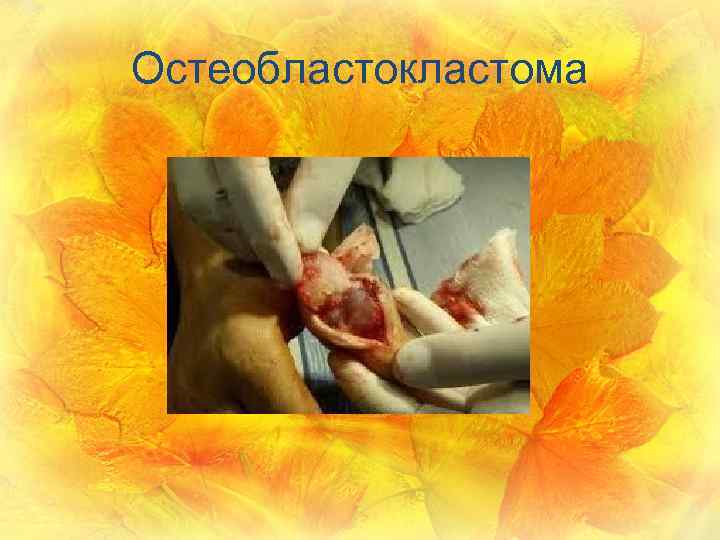 Остеобластокластома 