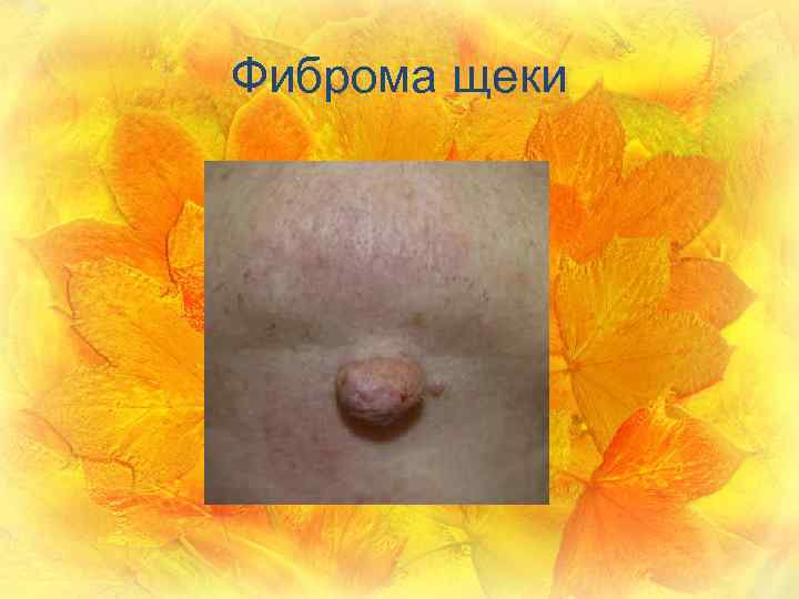 Фиброма щеки 