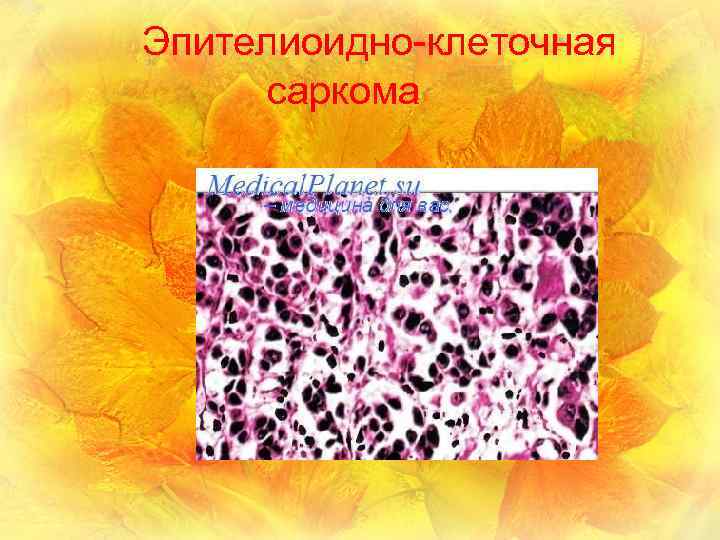 Эпителиоидно-клеточная саркома 