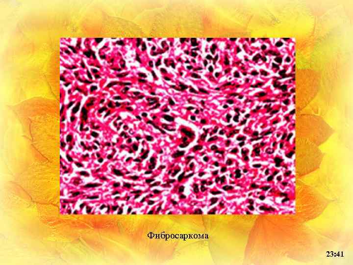 Фибросаркома 23: 41 