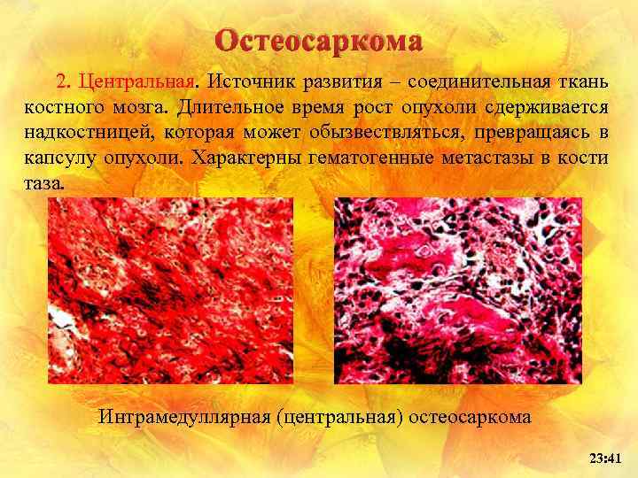 Остеосаркома 2. Центральная. Источник развития – соединительная ткань костного мозга. Длительное время рост опухоли