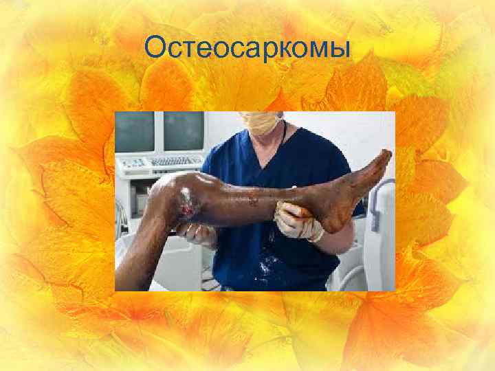 Остеосаркомы 