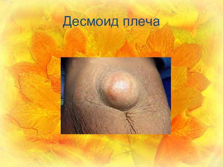 Десмоид плеча 