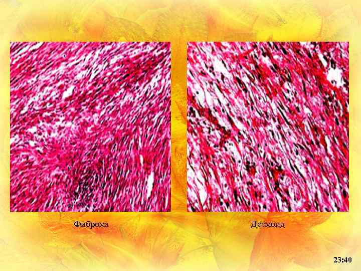 Фиброма Десмоид 23: 40 