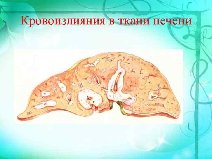 Кровоизлияния в ткани печени 