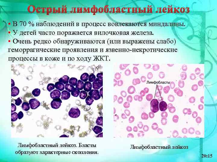 Острый лимфобластный лейкоз • В 70 % наблюдений в процесс вовлекаются миндалины. • У