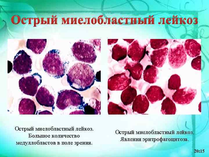 Острый миелобластный лейкоз. Большое количество медуллобластов в поле зрения. Острый миелобластный лейкоз. Явления эритрофагоцитоза.