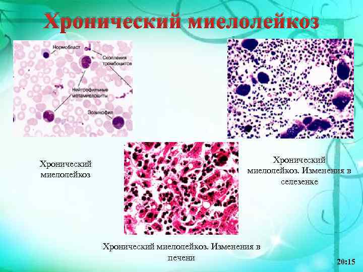 Хронический миелолейкоз. Изменения в селезенке Хронический миелолейкоз. Изменения в печени 20: 15 