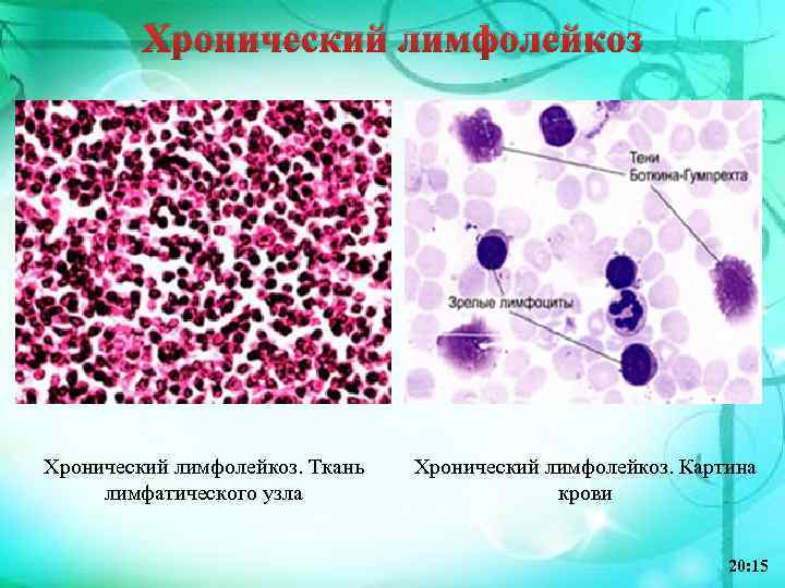 Хронический лимфолейкоз. Ткань лимфатического узла Хронический лимфолейкоз. Картина крови 20: 15 