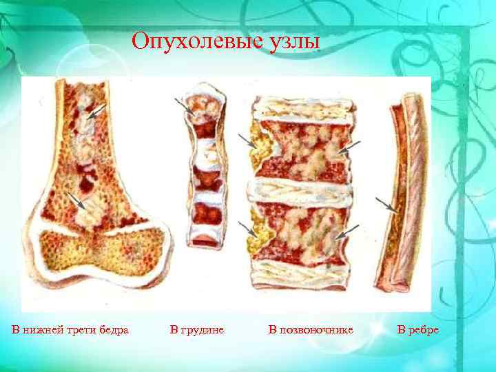 Опухолевые узлы В нижней трети бедра В грудине В позвоночнике В ребре 