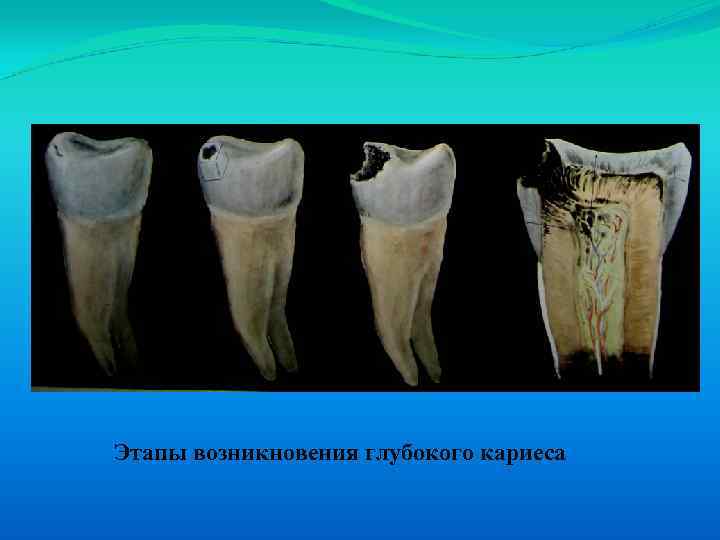 Этапы возникновения глубокого кариеса 