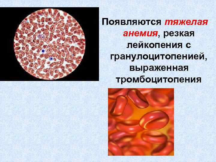 Появляются тяжелая анемия, резкая лейкопения с гранулоцитопенией, выраженная тромбоцитопения 