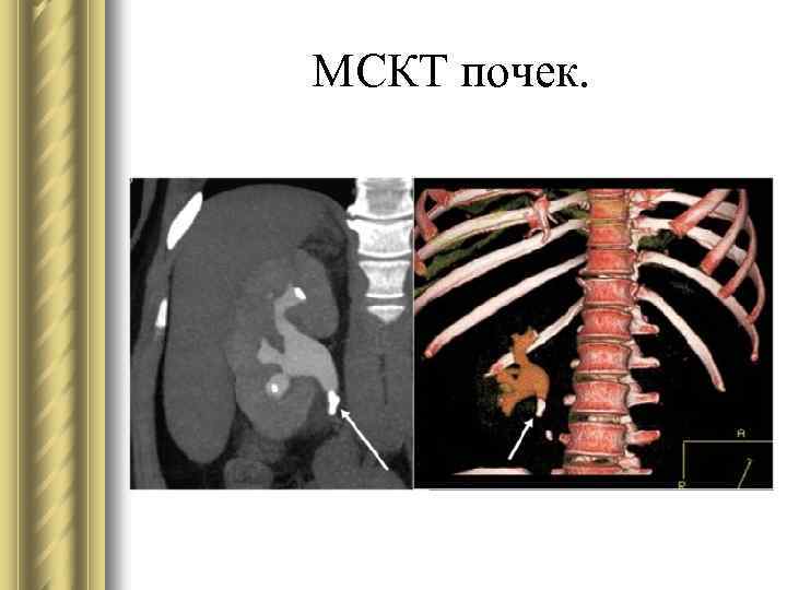 МСКТ почек. 