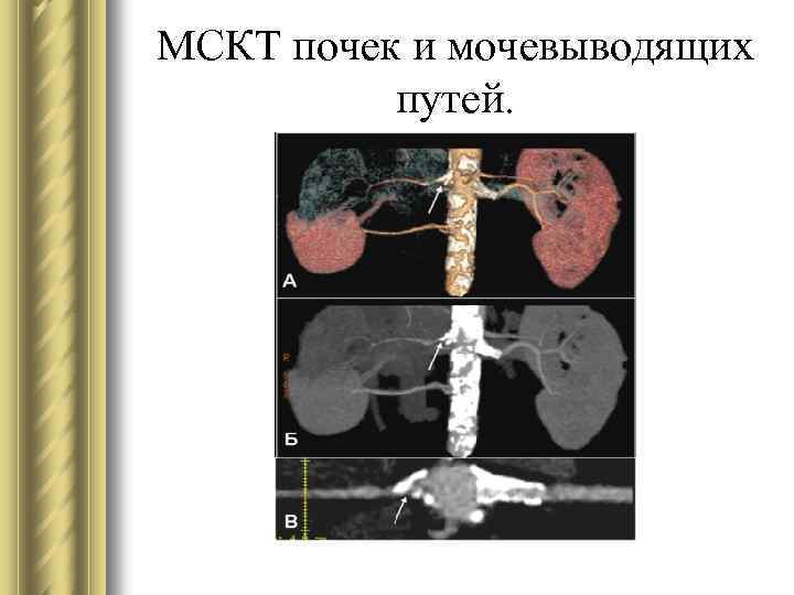 МСКТ почек и мочевыводящих путей. 