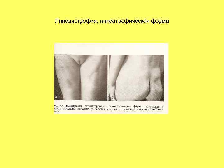 Липодистрофия, липоатрофическая форма 