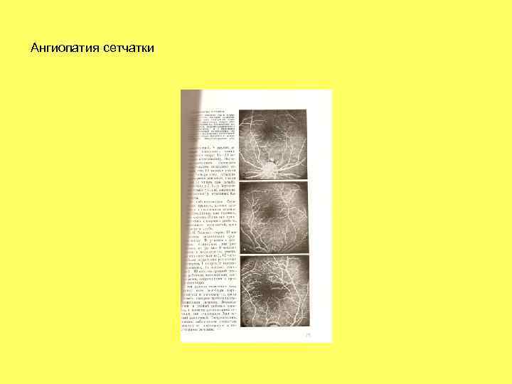 Ангиопатия сетчатки 