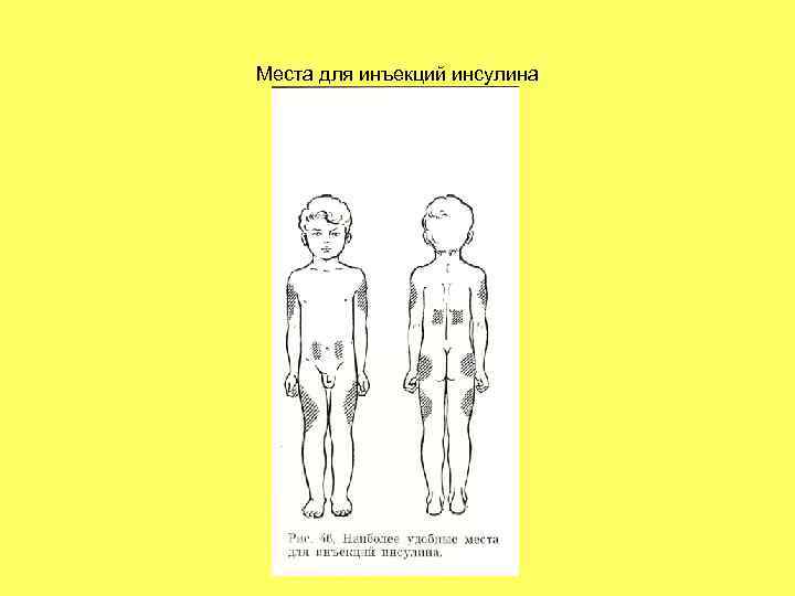 Места для инъекций инсулина 