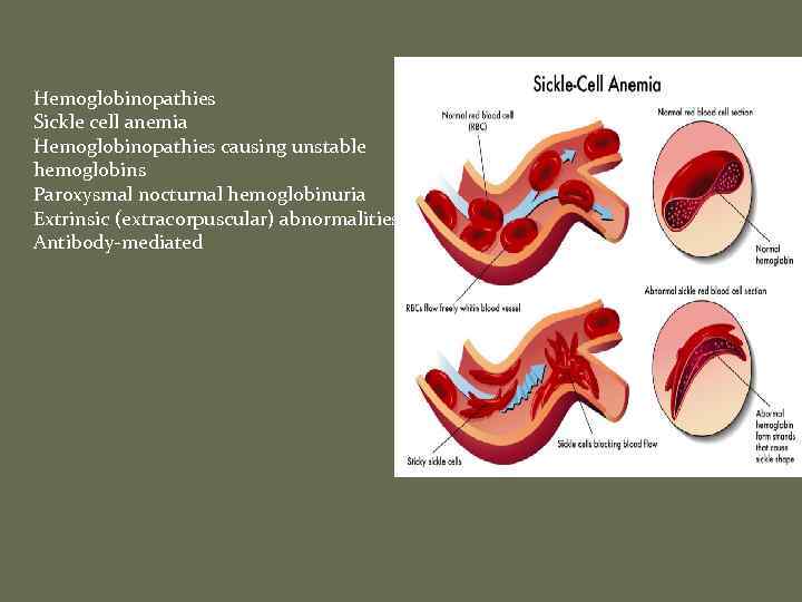 Hemoglobinopathies Sickle cell anemia Hemoglobinopathies causing unstable hemoglobins Paroxysmal nocturnal hemoglobinuria Extrinsic (extracorpuscular) abnormalities