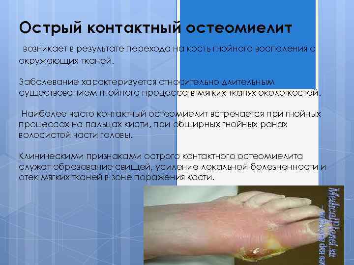 Острый контактный остеомиелит возникает в результате перехода на кость гнойного воспаления с окружающих тканей.