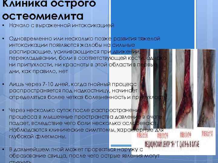 Клиника острого остеомиелита • Начало с выраженной интоксикацией • Одновременно или несколько позже развития