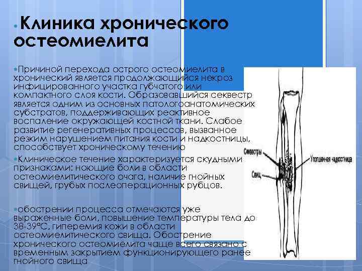 Острый остеомиелит диагностика