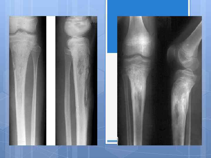 Рентгенологическая картина остеомиелита