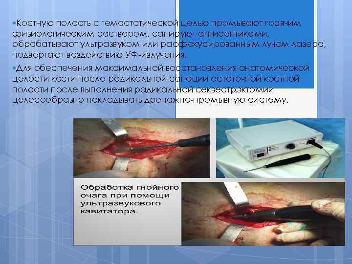  Костную полость с гемостатической целью промывают горячим физиологическим раствором, санируют антисептиками, обрабатывают ультразвуком