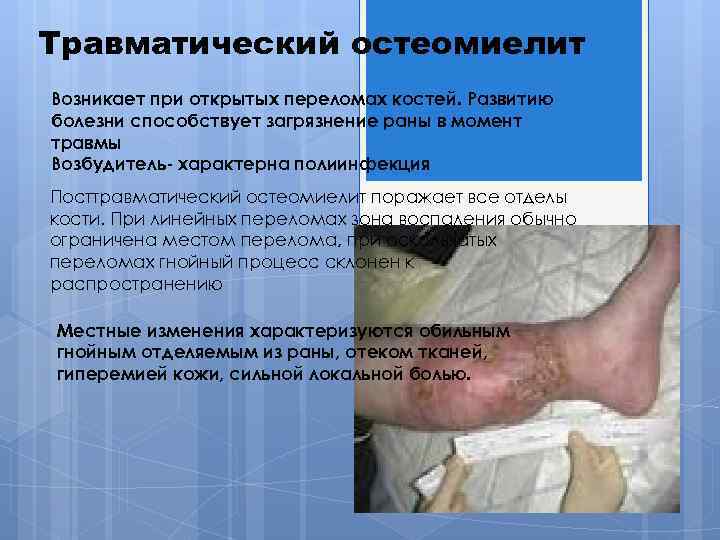 Травматический остеомиелит Возникает при открытых переломах костей. Развитию болезни способствует загрязнение раны в момент