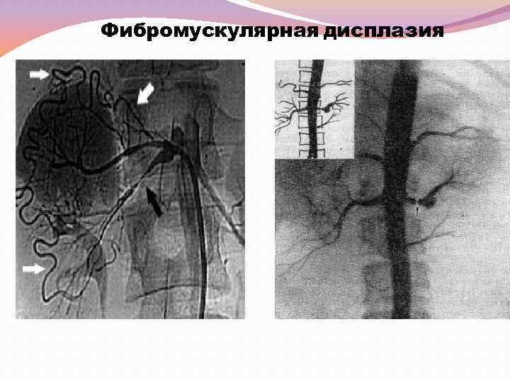 Фибромускулярная дисплазия 